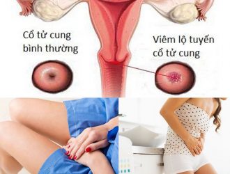 u-nang-buong-trung-la-benh-gi